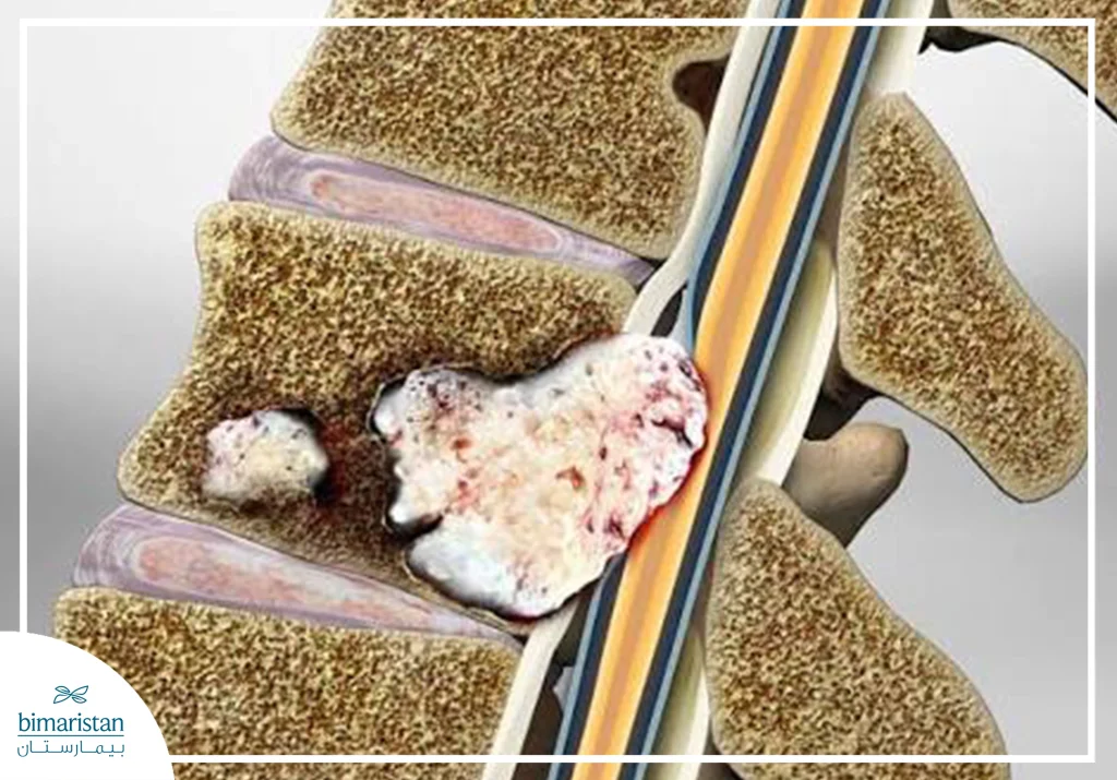 كل ما تريد معرفته عن سرطان العمود الفقري