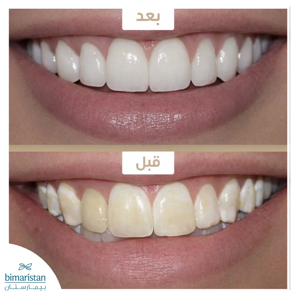لومينير الأسنان قبل وبعد