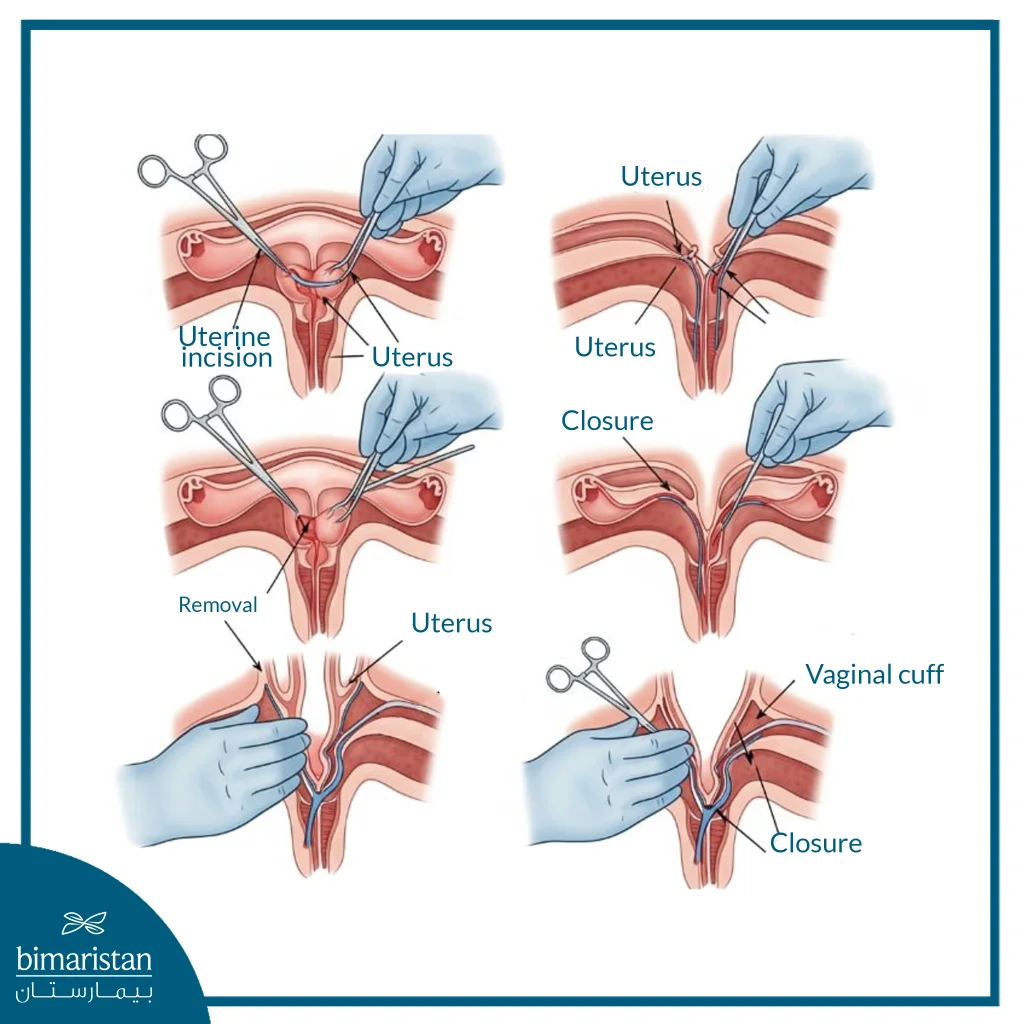 Surgical Steps Illustrating Hysterectomy And Closure Of The Vaginal Cuff After Uterus Removal.