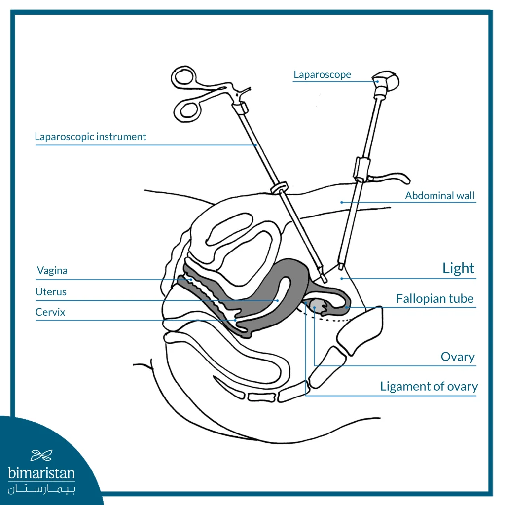 Diagram Showing Laparoscopic Instruments And Their Insertion Points During Abdominal Surgery.