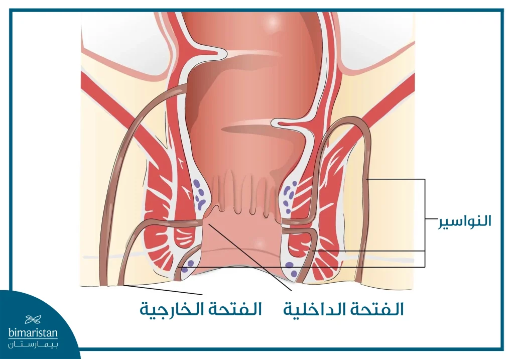 توضح الصورة ناسورًا شرجيًا، حيث يظهر مسار غير طبيعي يصل بين القناة الشرجية (الفتحة الداخلية) والجلد الخارجي (الفتحة الخارجية)، مع قنوات متفرعة حول المنطقة الشرجية.