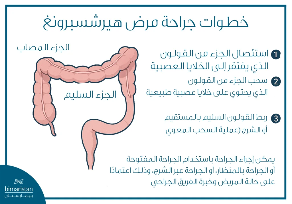 توضح الصورة علاج داء هيرشسبرونغ جراحياً، حيث يتم استئصال الجزء المصاب من القولون الخالي من الأعصاب، ثم سحب الجزء السليم وتوصيله بالمستقيم أو الشرج.