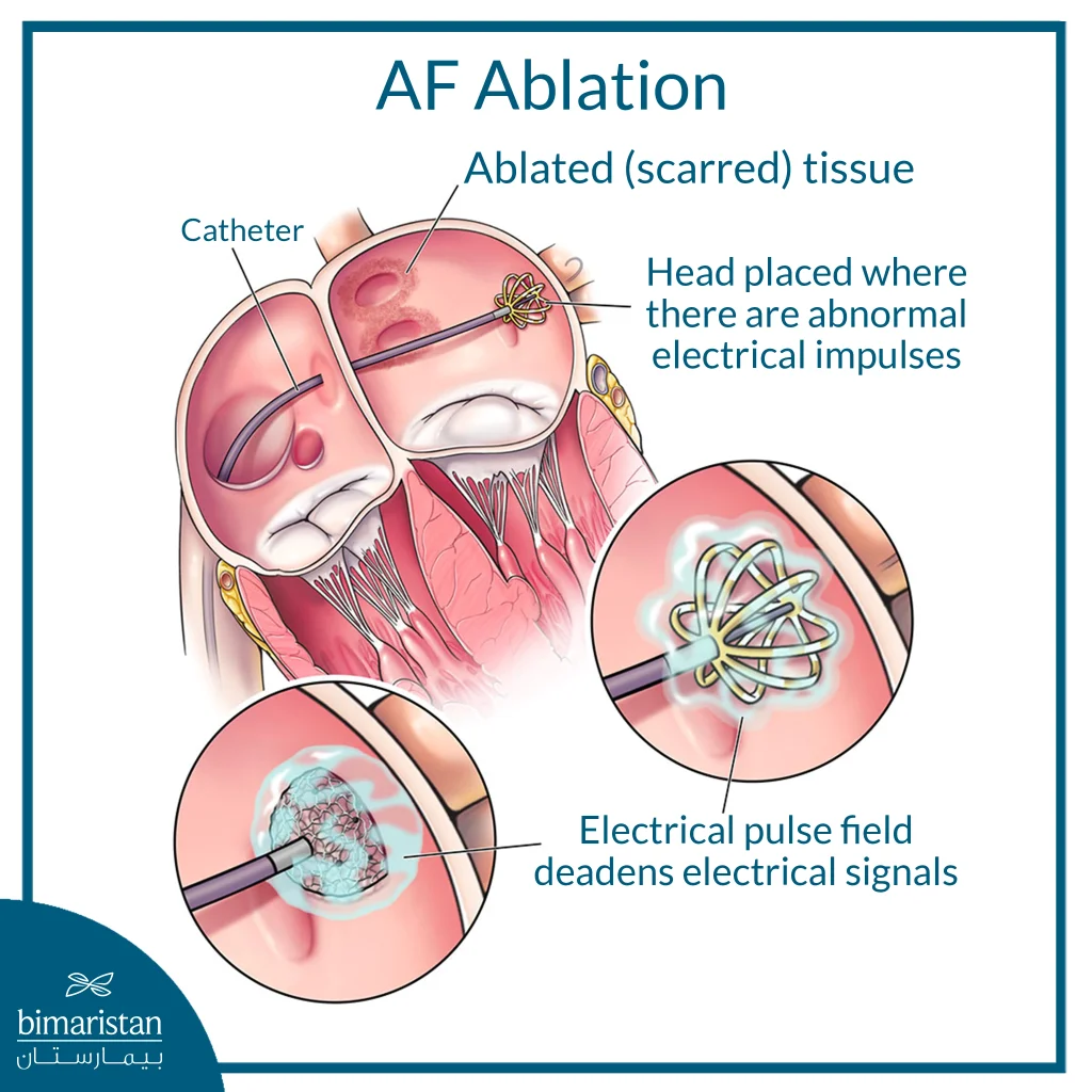 An Illustration Of A Catheter Ablation Procedure Showing The Insertion Of A Catheter Into The Atrium And Its Guidance Towards The Area Emitting Abnormal Electrical Signals, Followed By The Creation Of A Scar Tissue To Isolate The Tissue Responsible For The Disturbance And Prevent The Transmission Of Abnormal Signals, With Local Magnification Showing The Effect Of The Energy On The Heart Tissue.