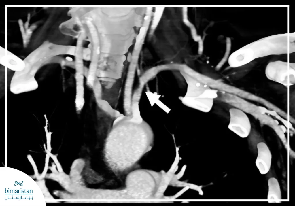 صورة طبقي محوري وعائي تُبيّن تضيقاً في الشريان تحت الترقوة عند منشئه من قوس الأبهر، كما هو محدد بالسهم، مع نقص واضح في قطر الوعاء مقارنةً بالجزء البعيد