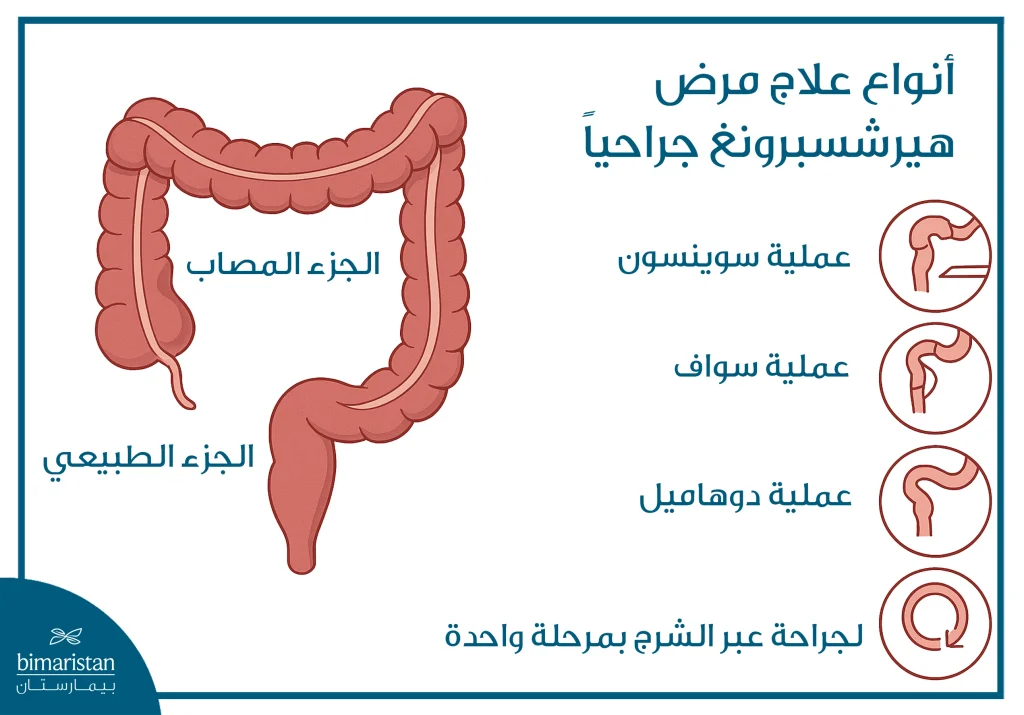 أنواع علاج داء هيرشسبرونغ جراحياً