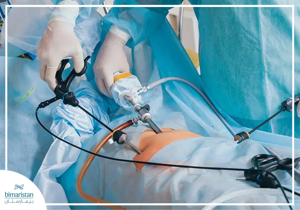 The Image Shows A Laparoscopic Surgical Procedure Performed Through Small Incisions In The Abdominal Wall. Specialized Instruments And A Camera-Equipped Laparoscope Are Inserted To Provide A Magnified View On An External Monitor, Allowing The Surgeon To Operate With High Precision While Minimizing Tissue Damage. This Technique Is Commonly Used In Various Abdominal And Gynecological Surgeries.