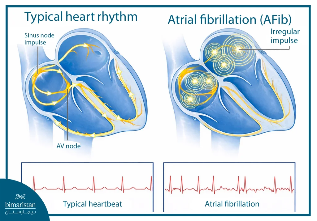 Illustration Showing Normal Heart Rhythm Versus Atrial Fibrillation, With Regular Electrical Conduction In The Normal Heart And Chaotic Atrial Impulses In Afib, Along With Comparative Ecg Tracings Below