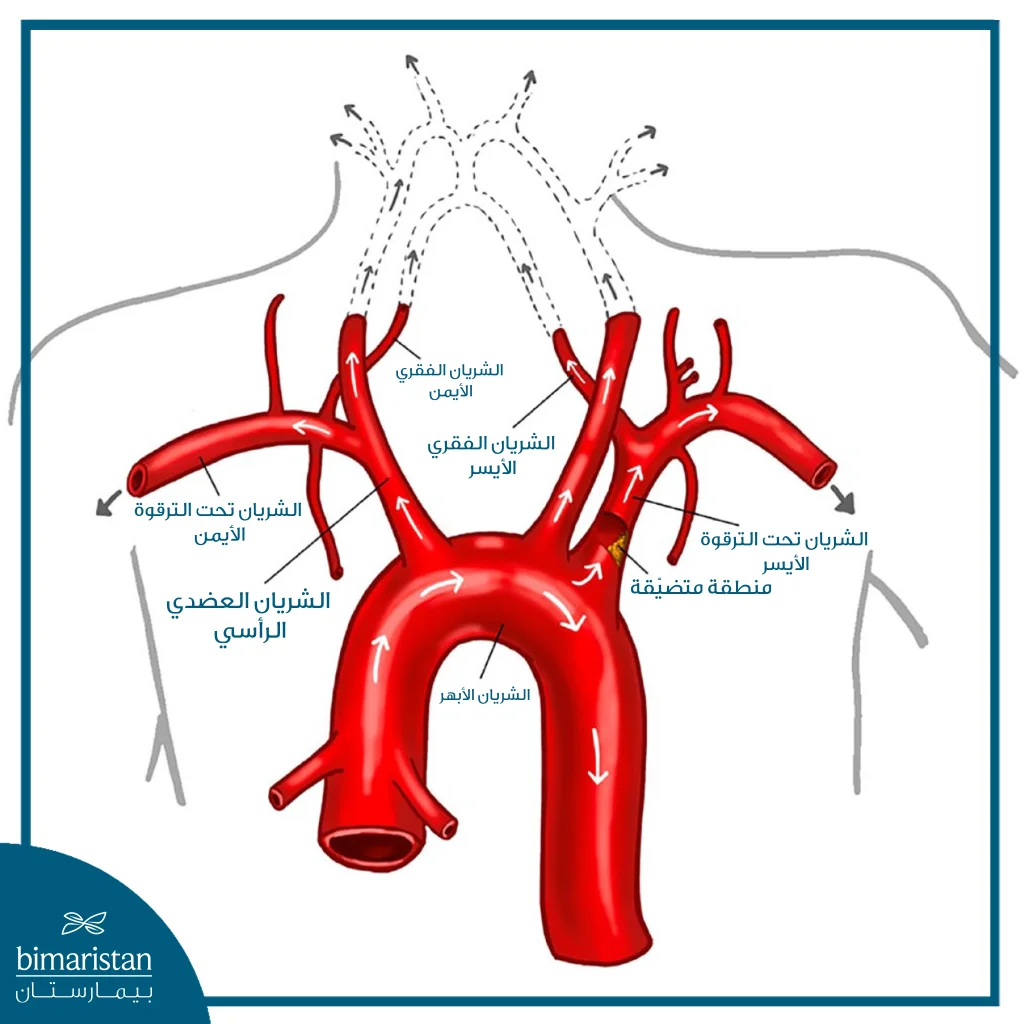 رسم توضيحي يبيّن الشريان الأبهر وفروعه الرئيسية، مع وجود تضيق في الشريان تحت الترقوة الأيسر وتأثيره على اتجاه تدفّق الدم في الشريان الفقري