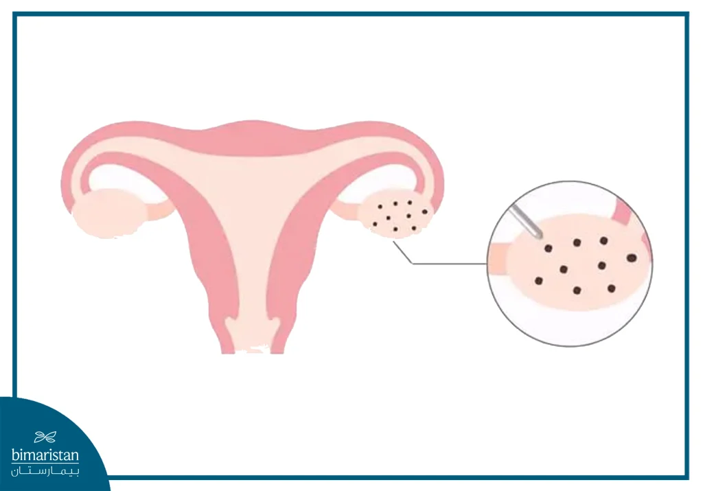 Illustration Of An Ovary Showing Multiple Small Cysts, Indicating A Condition Such As Polycystic Ovary Syndrome.