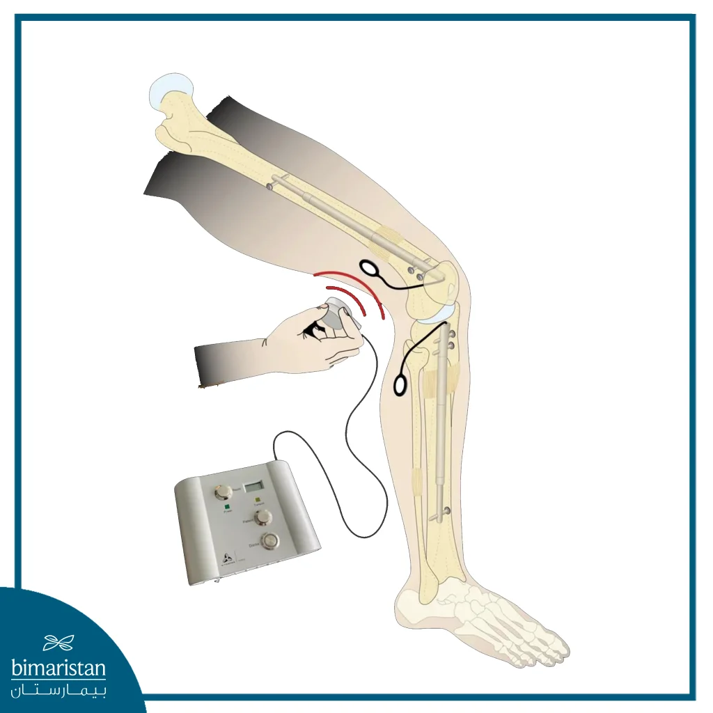A Simplified Illustration Showing The Implanted Intramedullary Nail And How It Is Controlled In This Technique