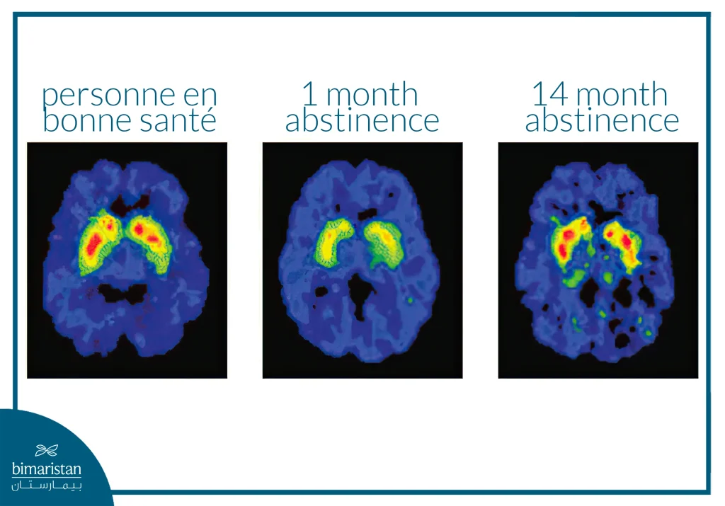 Addiction Au Shabu (Méthamphétamineou Crystal) : Symptômes Et Traitements 2 Addiction Au Shabu