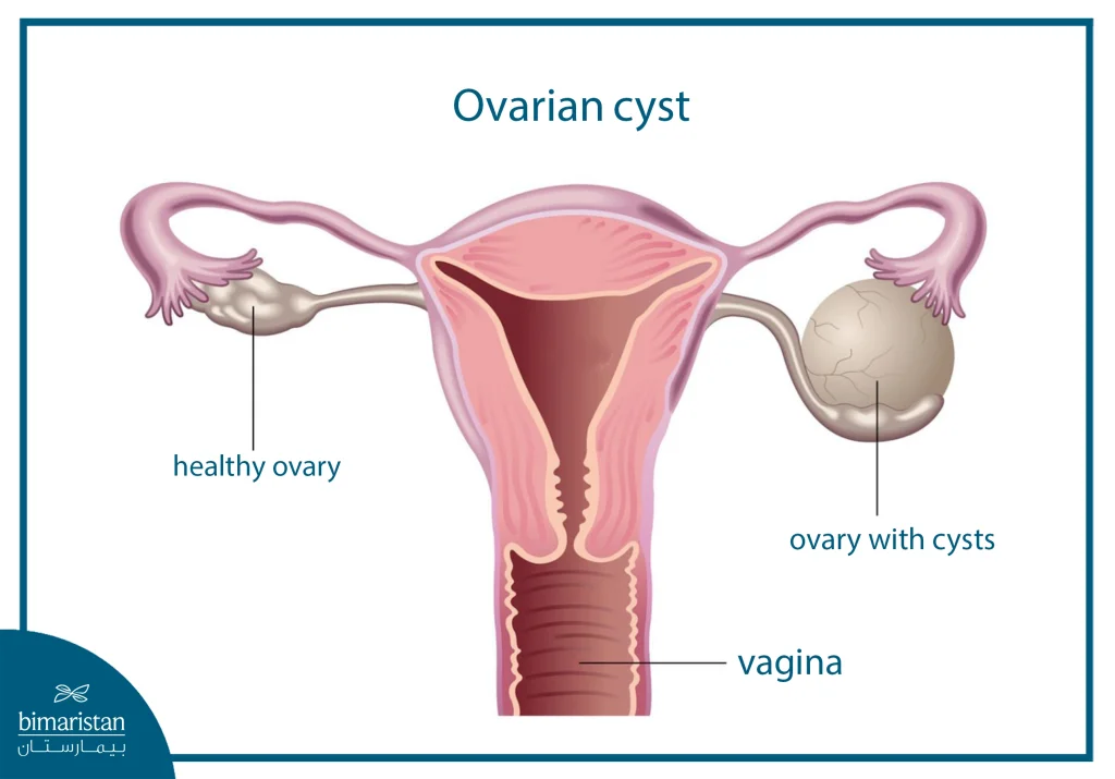 Laparoscopic Ovarian Cystectomy: Causes, Procedure, Complications, And Cost 2 An Anatomical Diagram Comparing A Healthy Ovary With An Ovary Containing A Cyst.