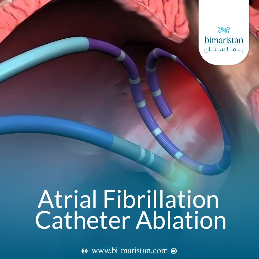Atrial Fibrillation Catheter Ablation: A Comprehensive Guide To Treatment, Procedures And Outcomes