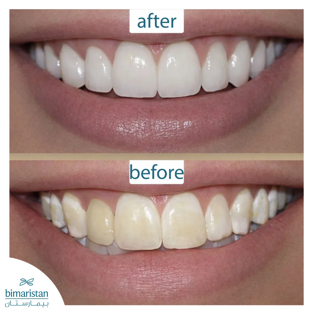 Dental Lumineers: The Secret To An Attractive Smile 3 Dental Lumineers Before And After