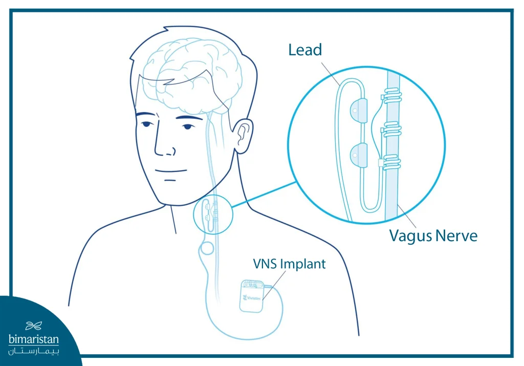 Vagus Nerve Stimulation For Epilepsy: How It Works And Who It Helps 3 Device Implantation Process