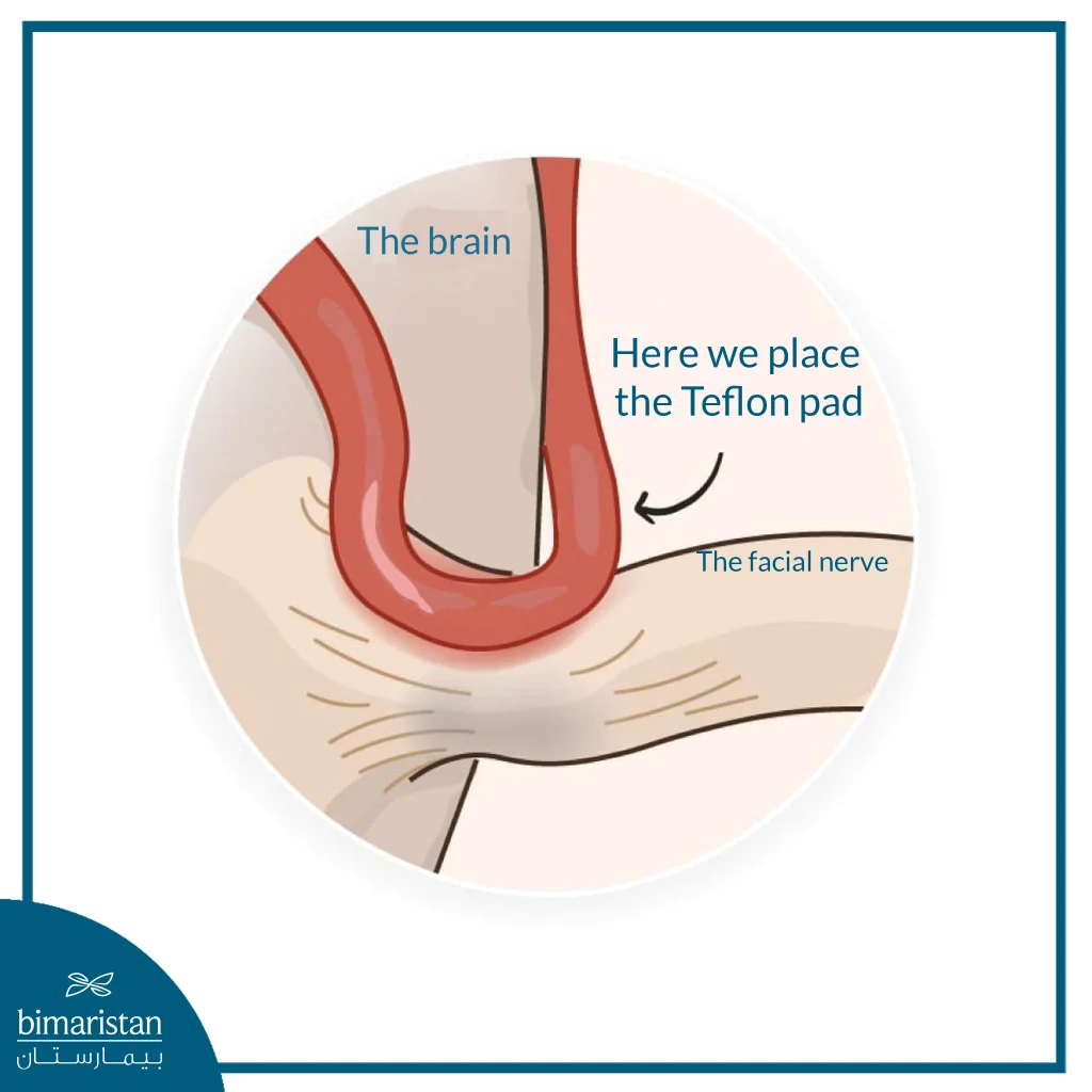 Diagram Showing Compression Of A Blood Vessel On The Facial Nerve At The Brainstem, A Common Cause Of Hemifacial Spasm