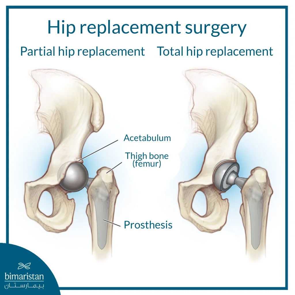 Everything You Need To Know About Hip Joint Surgery