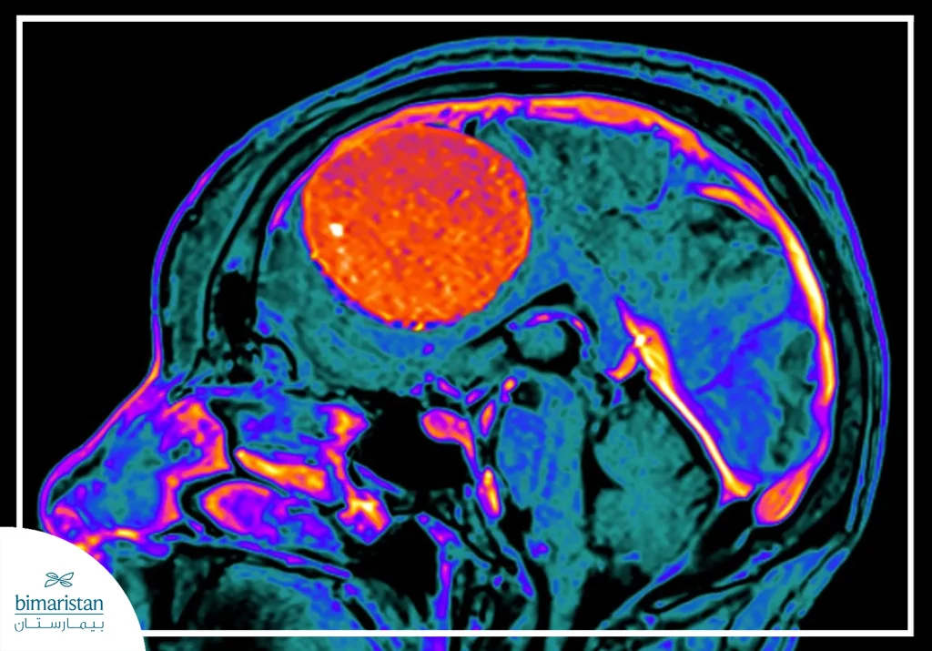 Image Of A Meningioma