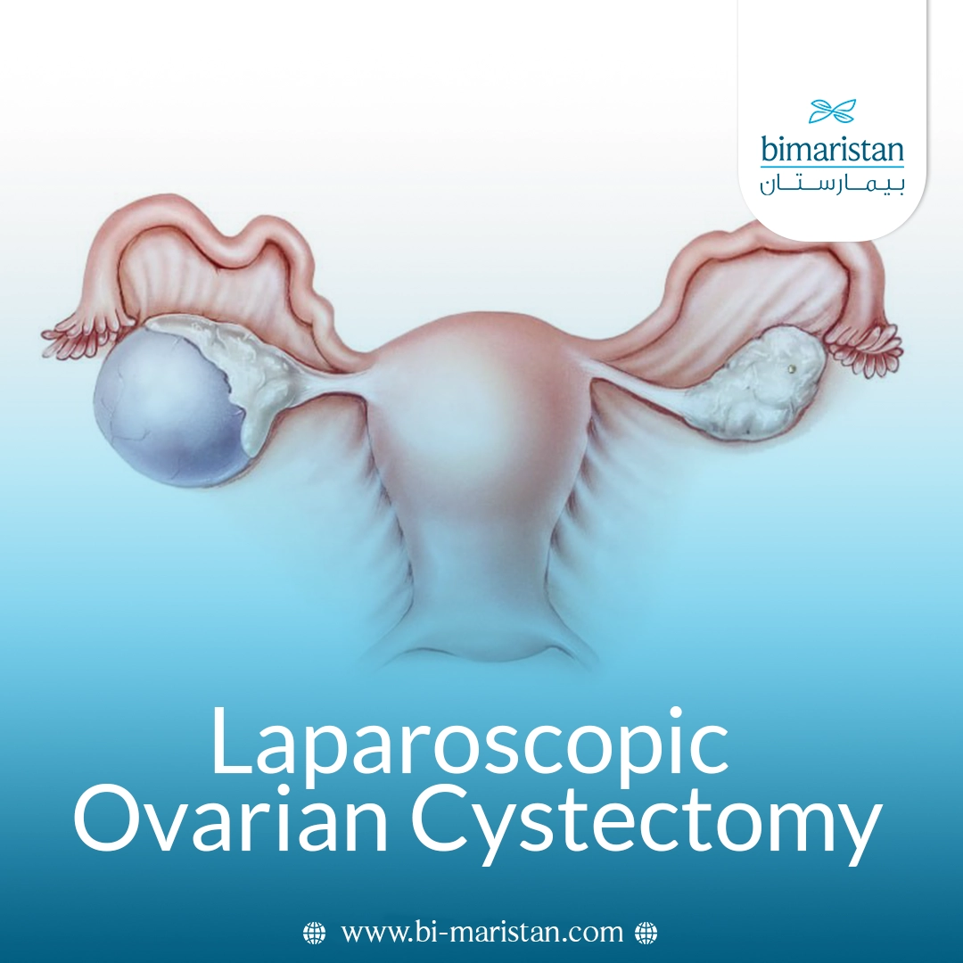 Laparoscopic Ovarian Cystectomy: Causes, Procedure, Complications, And Cost 6 Laparoscopic Ovarian Cystectomy: Causes, Procedure, Complications, And Cost