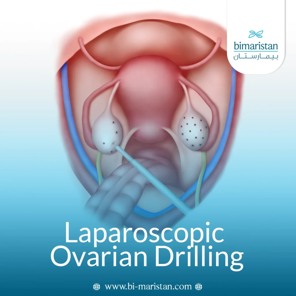 Laparoscopic Ovarian Drilling