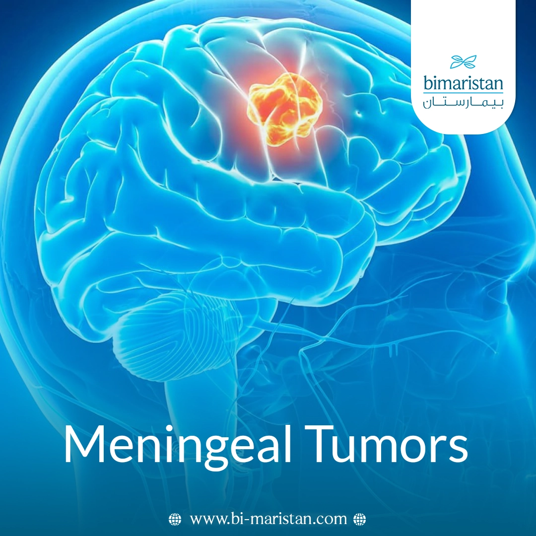 Meningiomas: Symptoms, Causes, And Modern Treatment Options 2 Meningiomas: Symptoms, Causes, And Modern Treatment Options