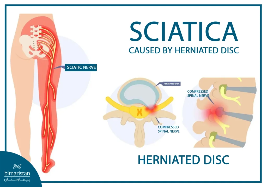 The Relationship Between Sciatica And Herniated Disc In The Lower Limb