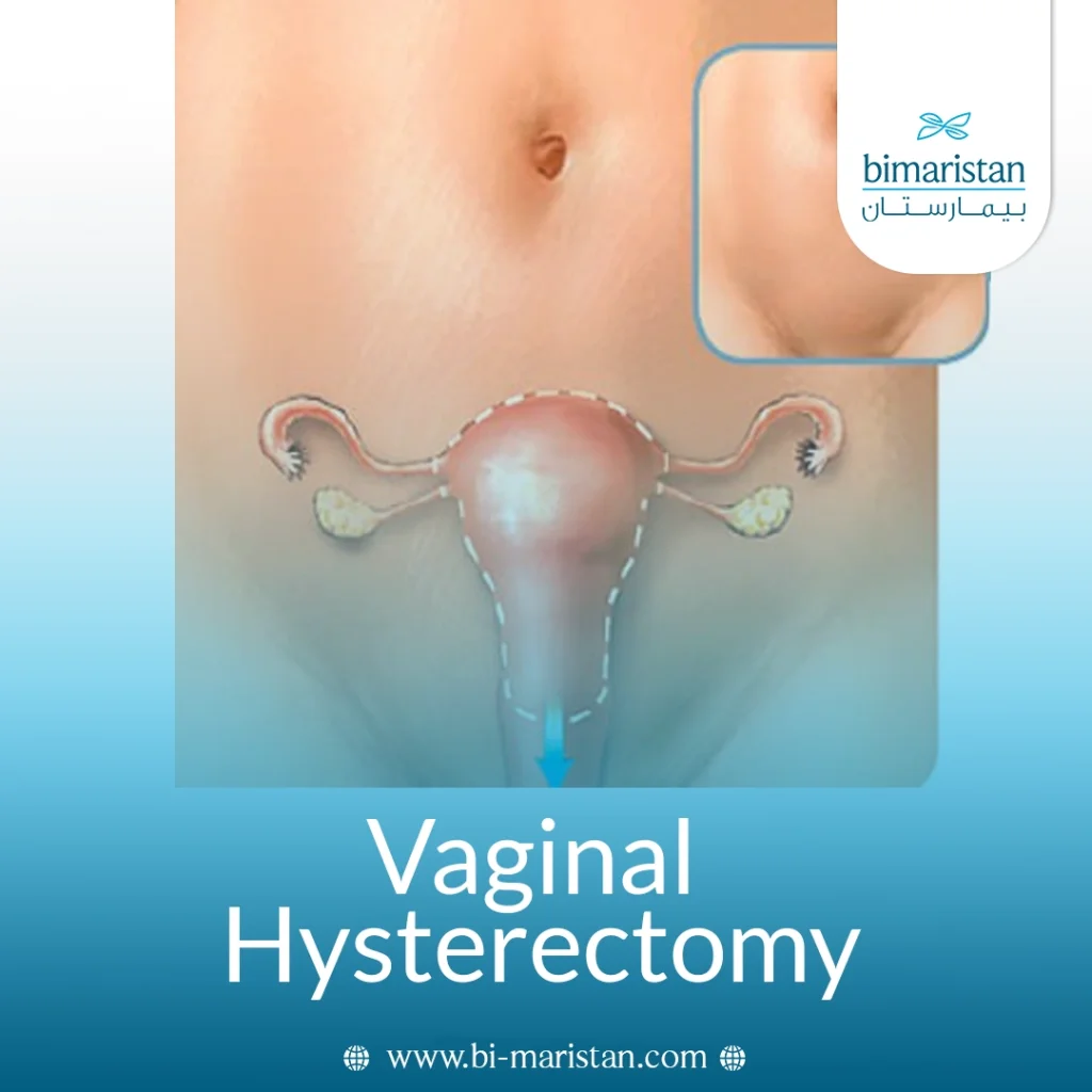 Vaginal Hysterectomy