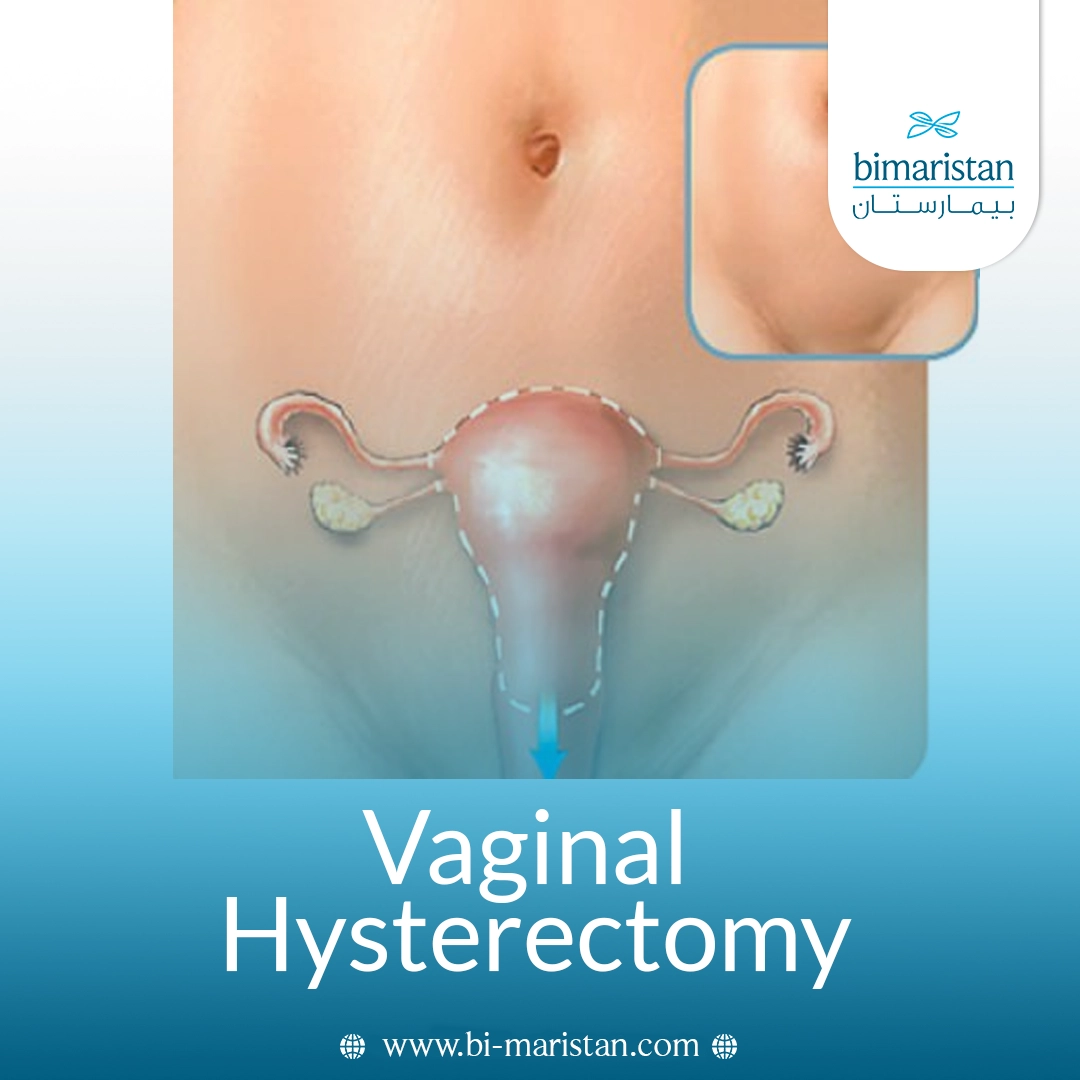 Vaginal Hysterectomy: A Comprehensive Guide To The Procedure, Benefits, And Risks