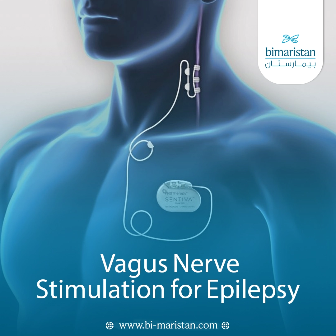 Vagus Nerve Stimulation For Epilepsy