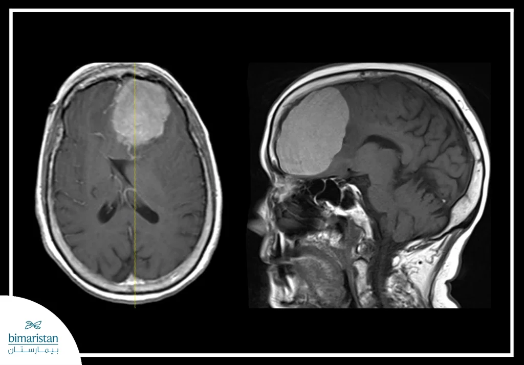 X-Ray Image Showing A Meningioma