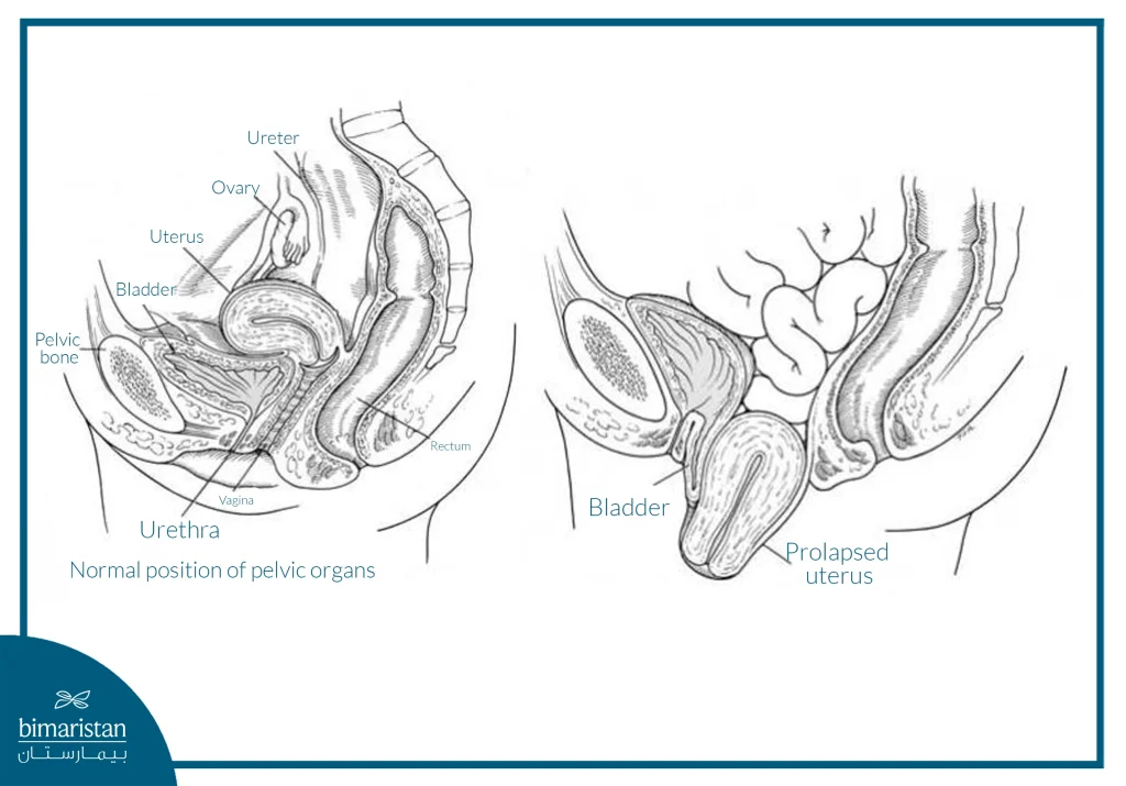 Comparison Between Normal Pelvic Organ Position And Uterine Prolapse.