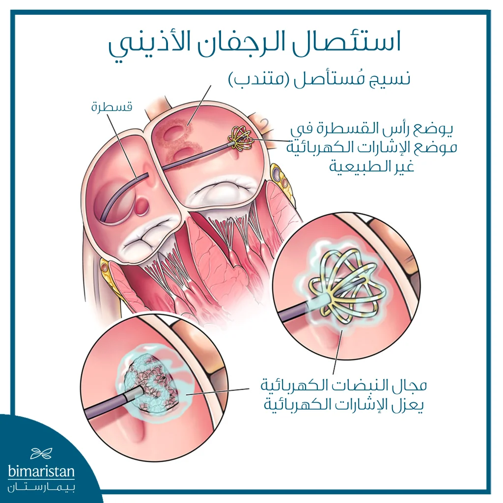 رسم توضيحي لإجراء استئصال الرجفان الأذيني بالقسطرة يُظهر إدخال القسطرة إلى الأذين وتوجيهها نحو المنطقة التي تصدر عنها إشارات كهربائية غير طبيعية، ثم إحداث منطقة متندبة لعزل النسيج المسؤول عن الاضطراب ومنع انتقال الإشارات الشاذة، مع تكبير موضعي يوضح تأثير الطاقة على نسيج القلب

