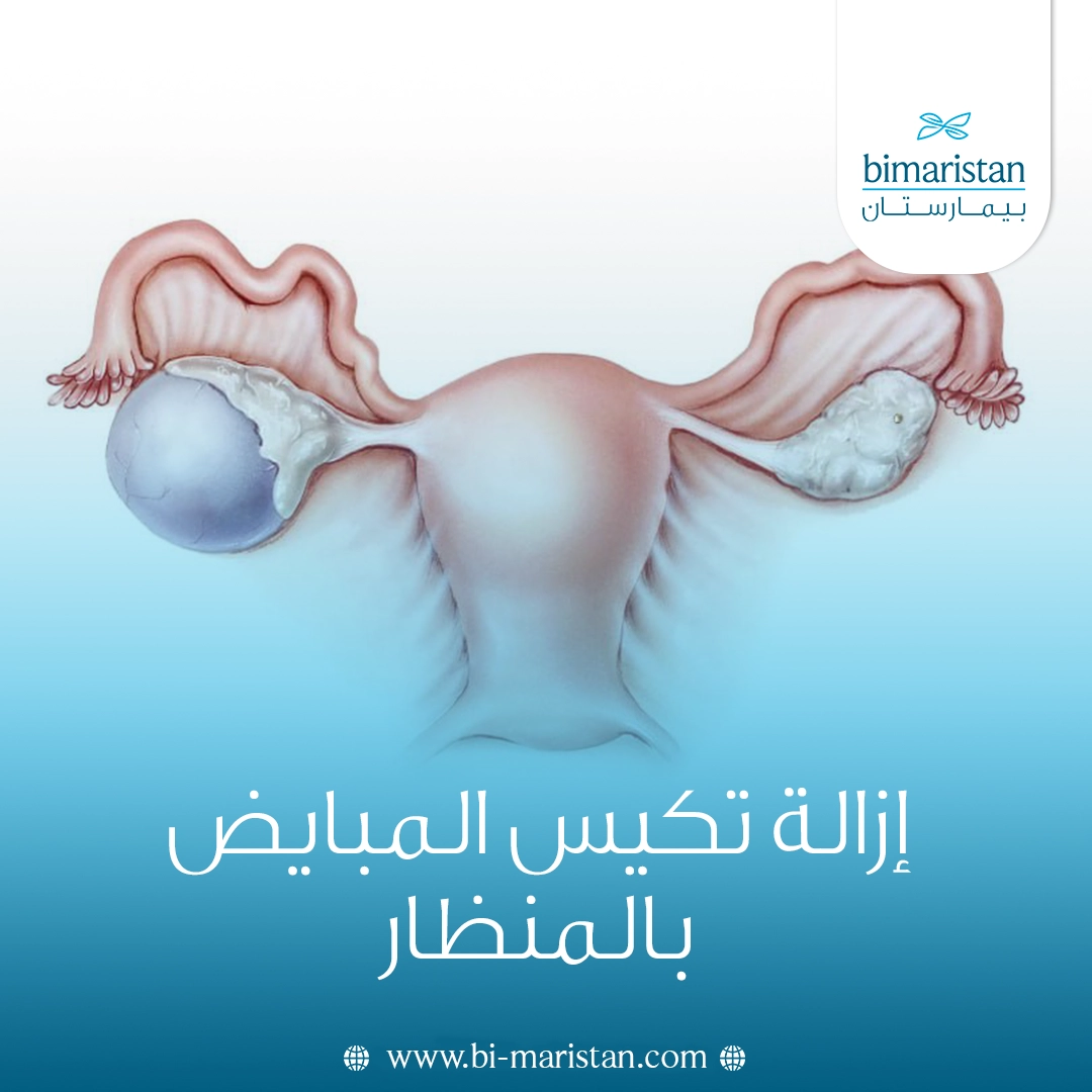 إزالة تكيس المبايض بالمنظار