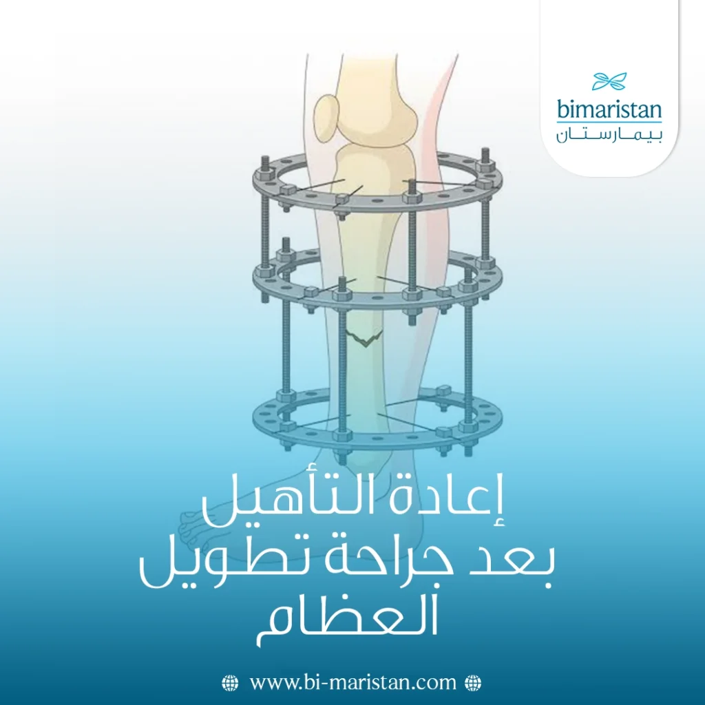 إعادة التأهيل بعد جراحة تطويل العظام