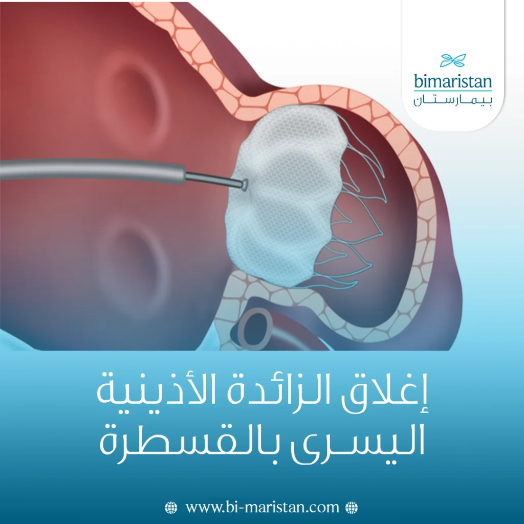 إغلاق الزائدة الأذينية اليسرى بالقسطرة