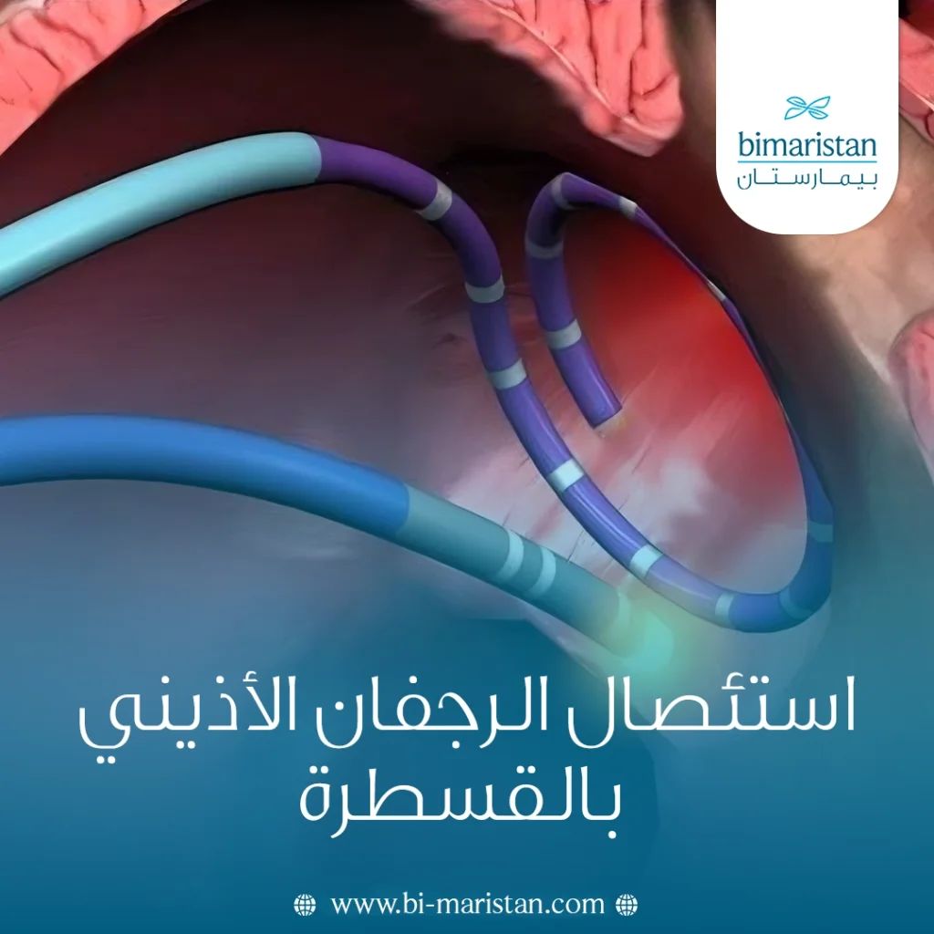استئصال الرجفان الأذيني بالقسطرة