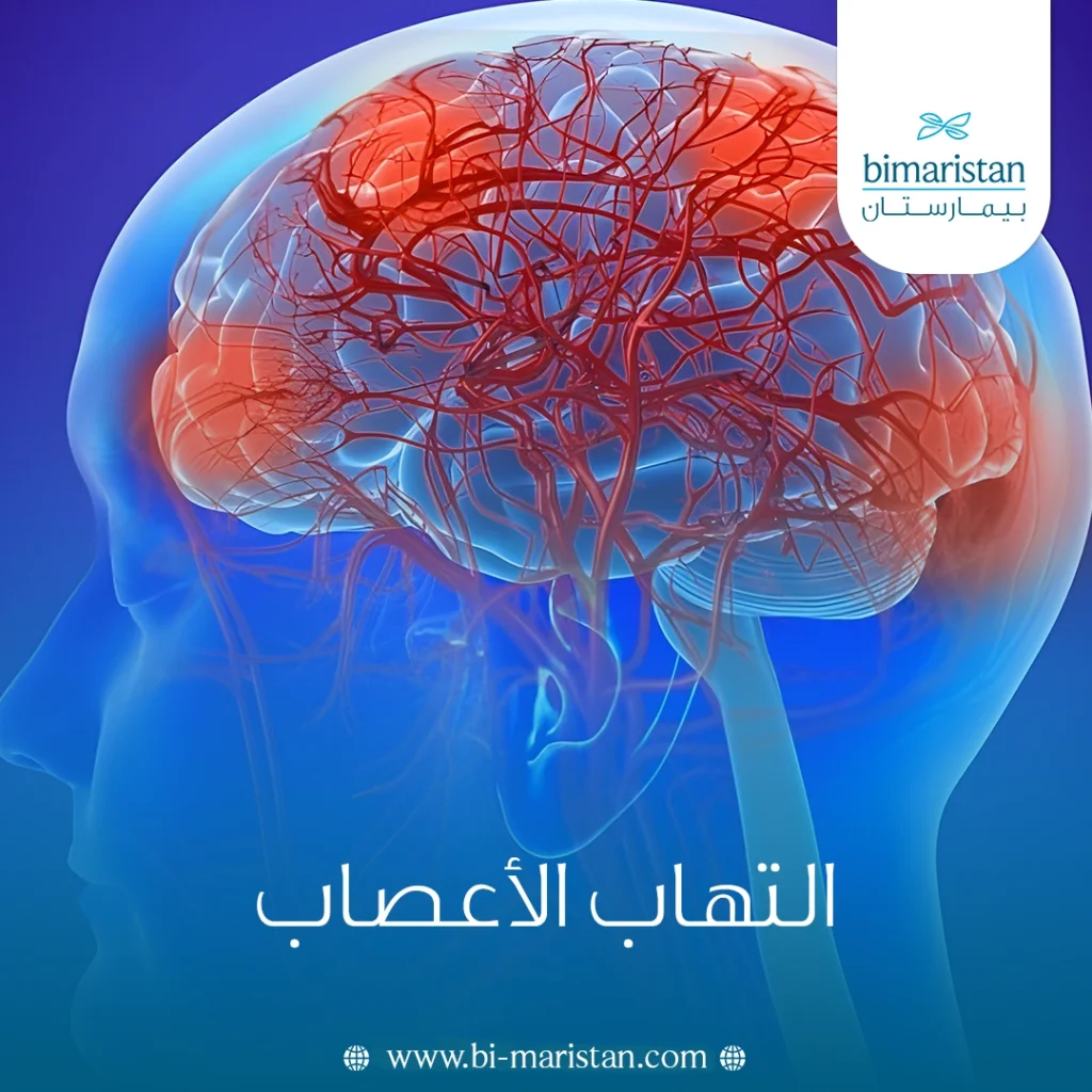 التهاب الأعصاب