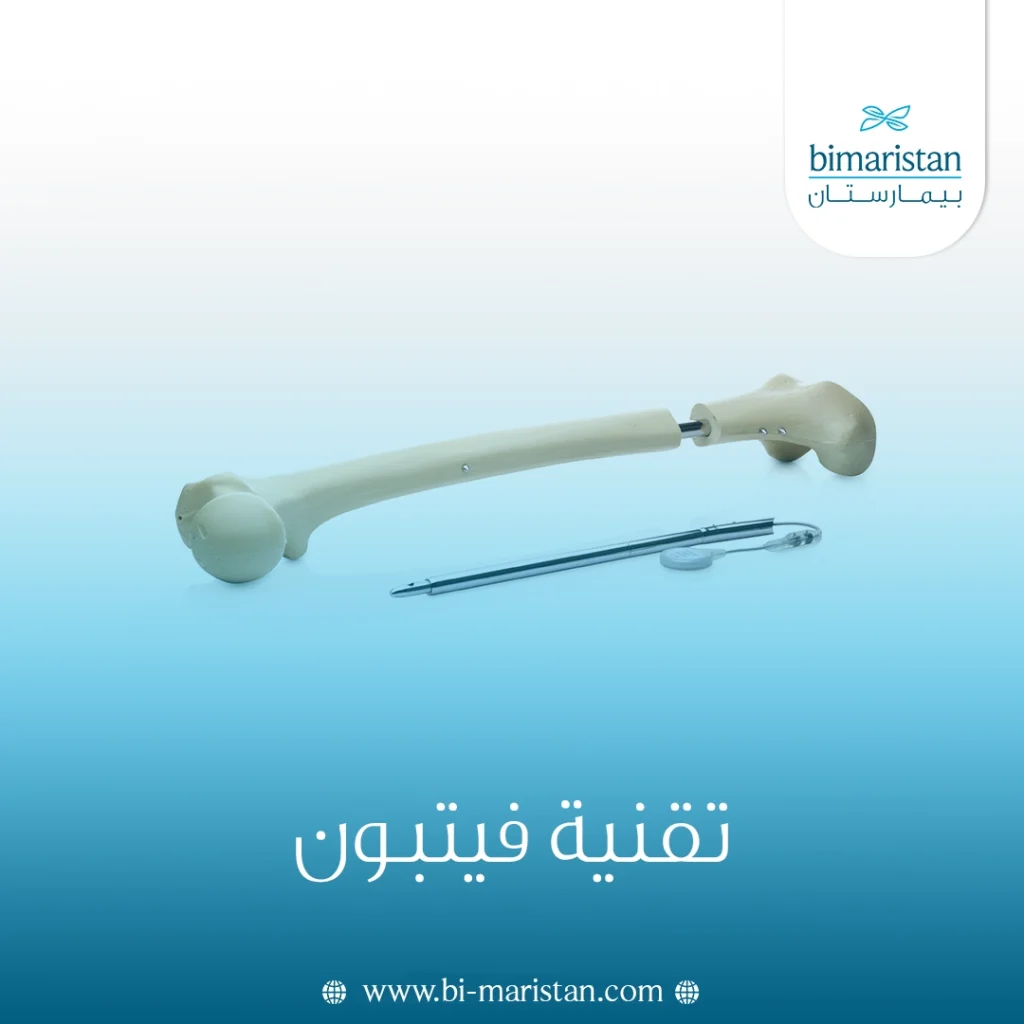 تقنية المسمار النخاعي (Fitbone) لإطالة العظام: كل ما تحتاج معرفته 16 تقنية فيتبون