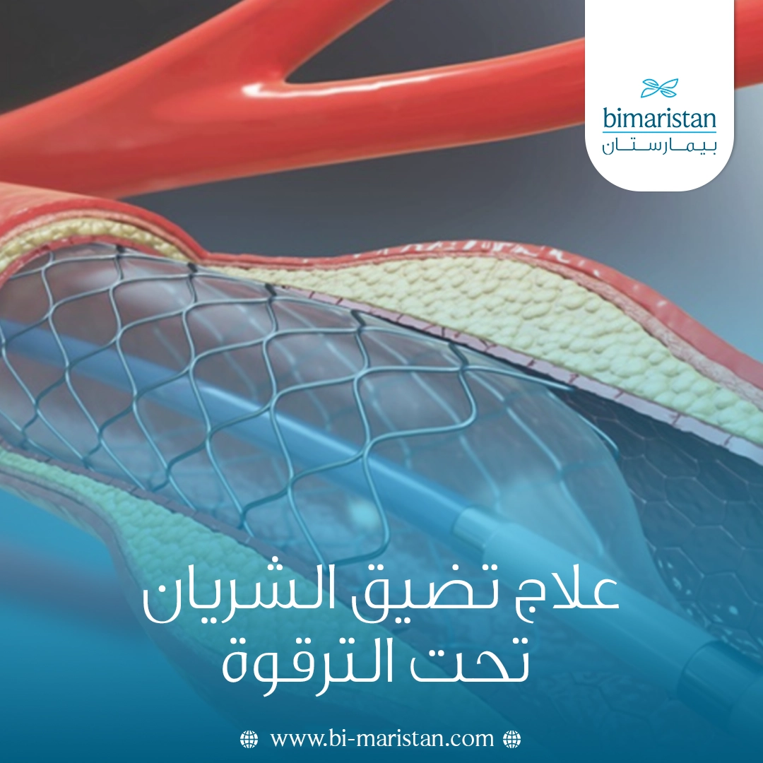 علاج تضيق الشريان تحت الترقوة