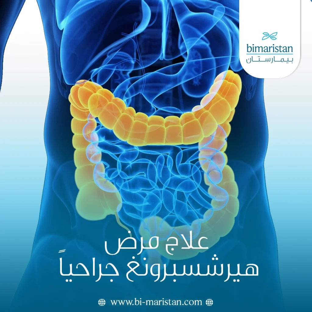 علاج مرض هيرشسبرونغ جراحياً