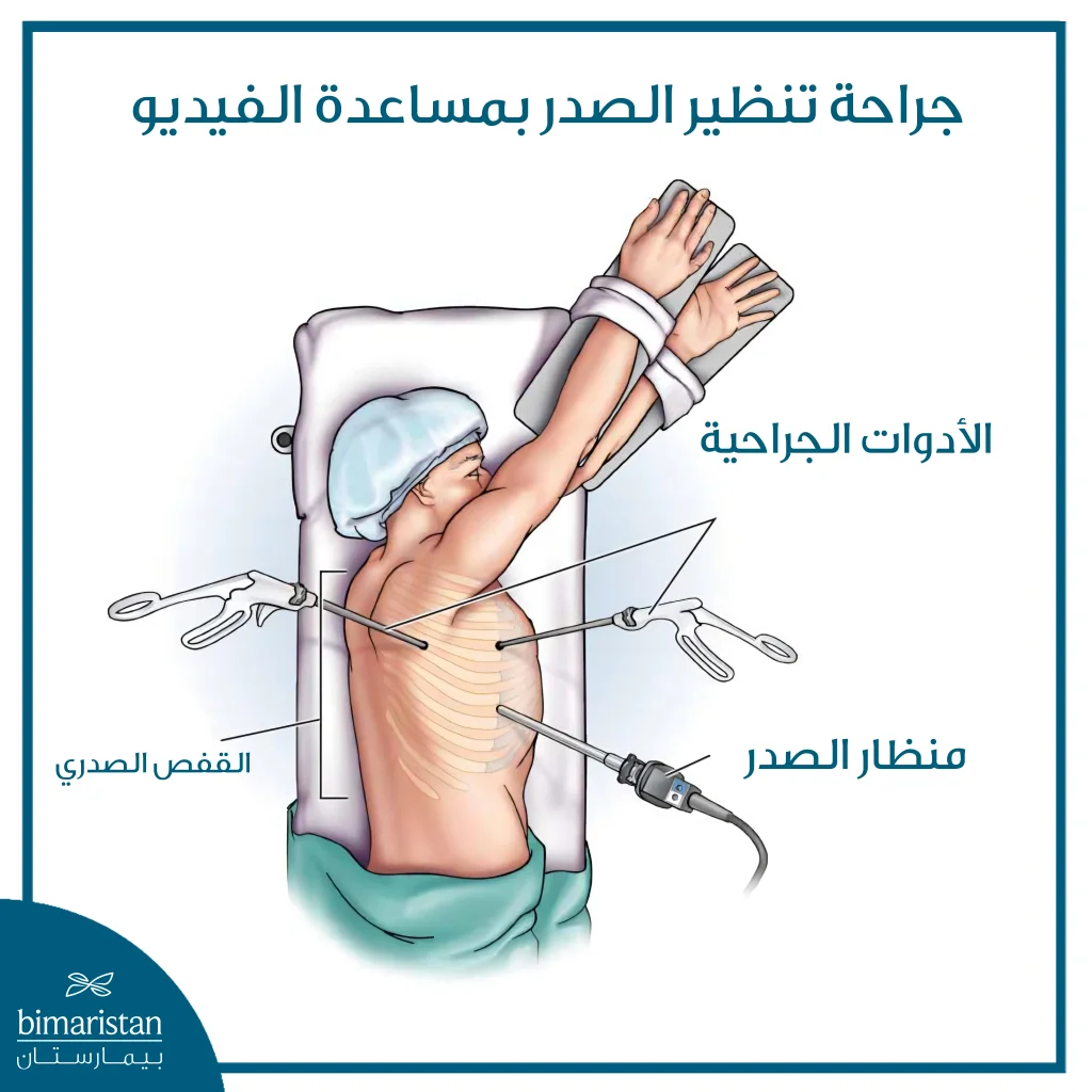 إجراء تنظير الصدر عبر شقوق صغيرة باستخدام المنظار والأدوات الجراحية