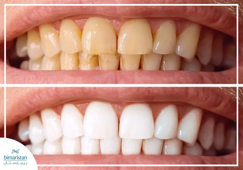 الفرق بين حالة الأسنان المصابة بالتصبغ الفوري وبعد التبييض
