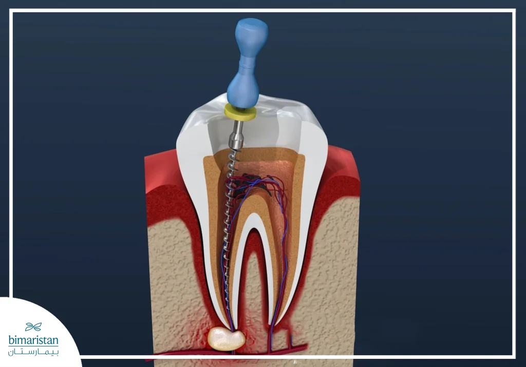 تصميم ثلاثي الأبعاد يوضح عملية علاج العصب