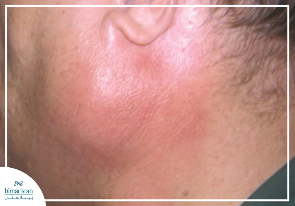 تورم أسفل الفك يدل على التهاب أو انسداد في الغدة اللعابية