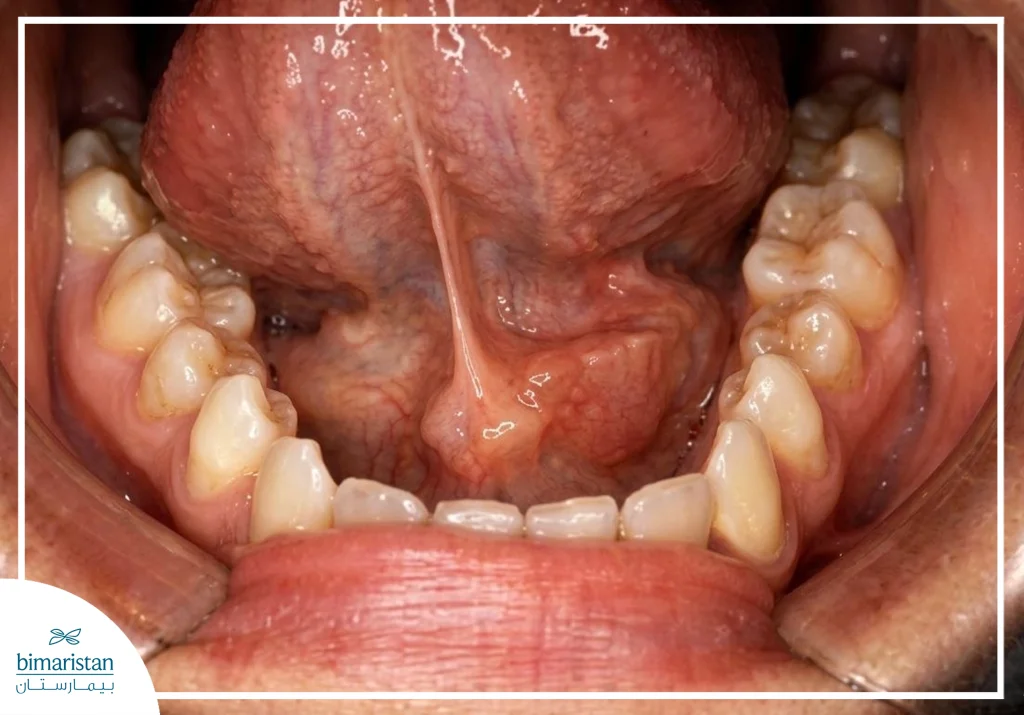 تورم في أرضية الفم أسفل اللسان بسبب انسداد القناة اللعابية