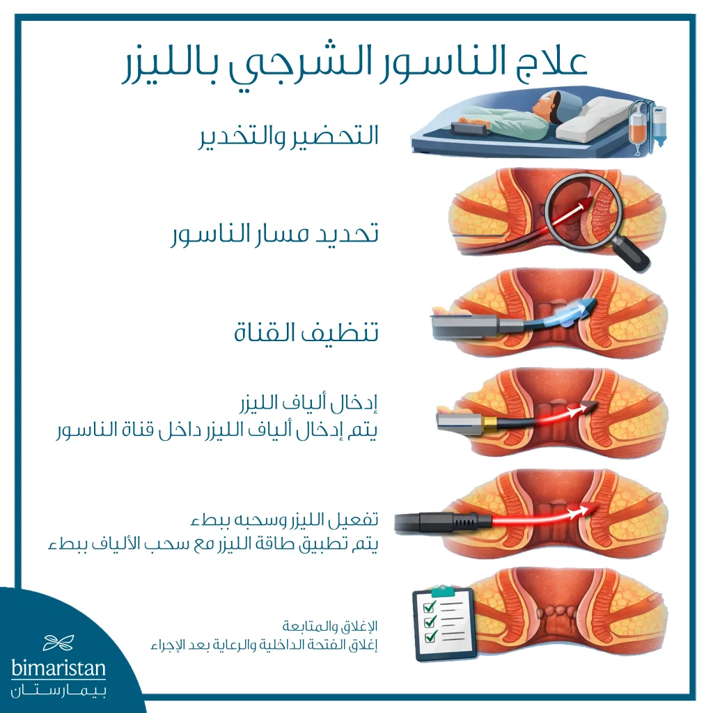 توضح الصورة خطوات علاج الناسور الشرجي بالليزر