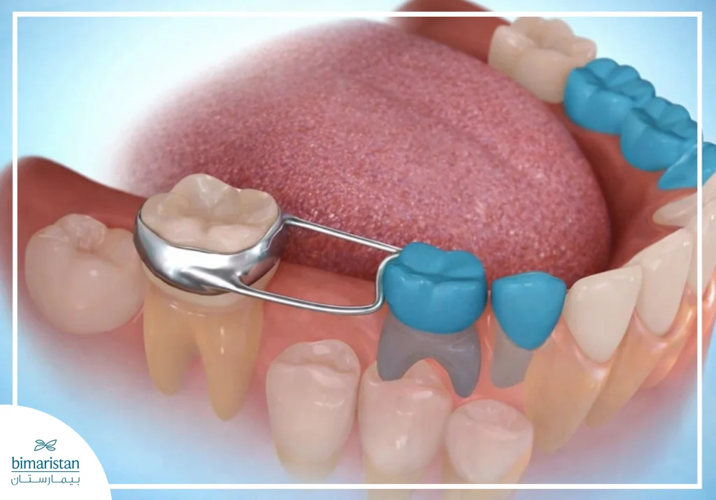 حافظة المسافة لمنع تحرك الأسنان واختلال الإطباق عند الأطفال