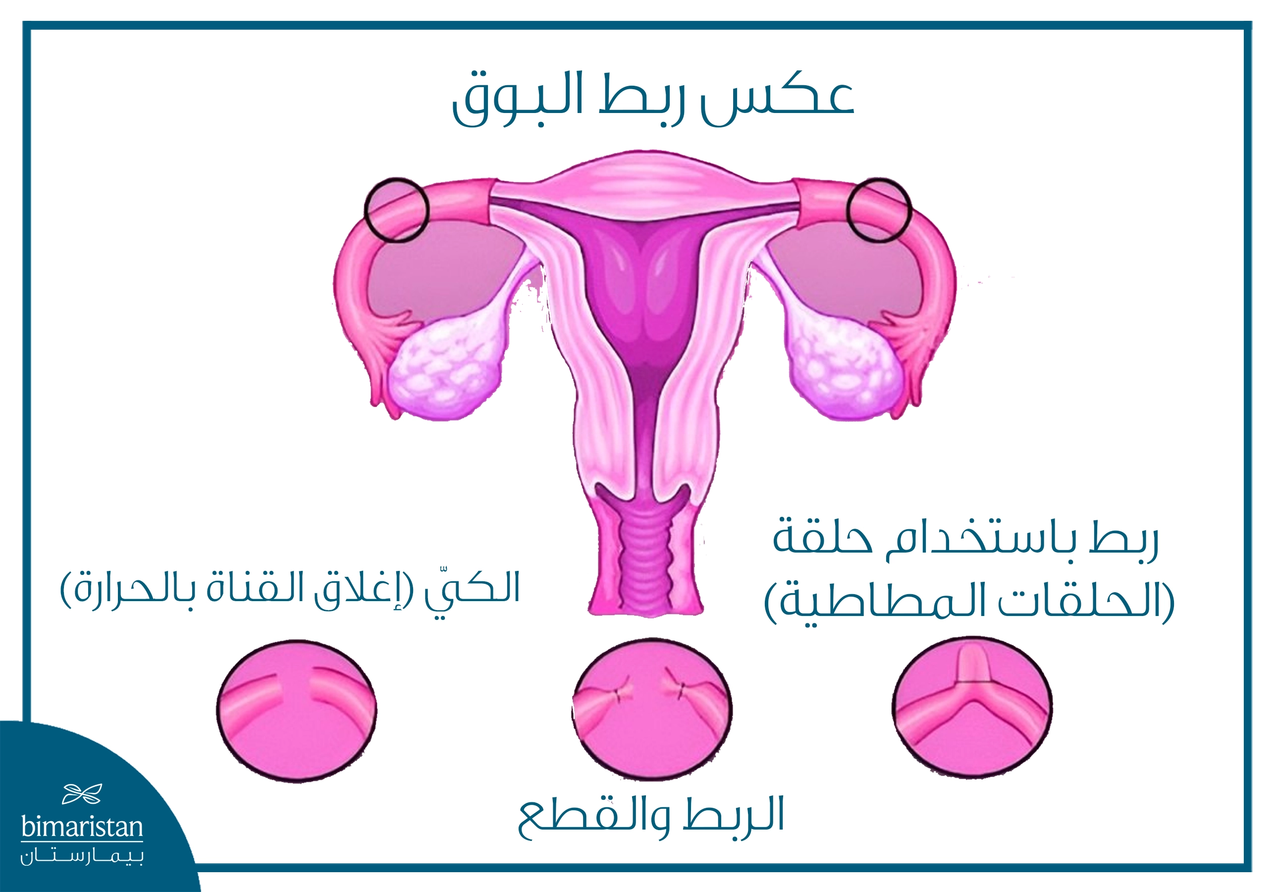 رسم توضيحي للجهاز التناسلي الأنثوي يبيّن قناتي فالوب مع توضيح طرق ربط البوق المختلفة (الكي، القطع والربط، الحلقات) قبل إجراء عكس ربط البوق.