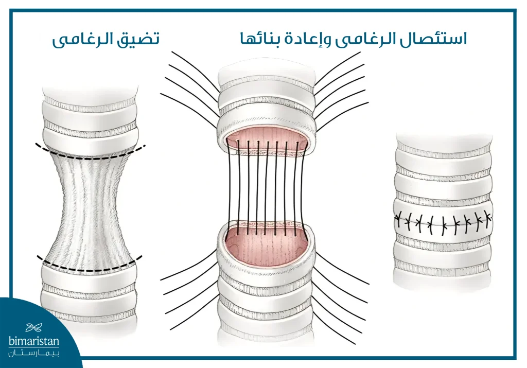 رسم توضيحي يبيّن تضيق الرغامى وجراحة استئصالها وإعادة بنائها