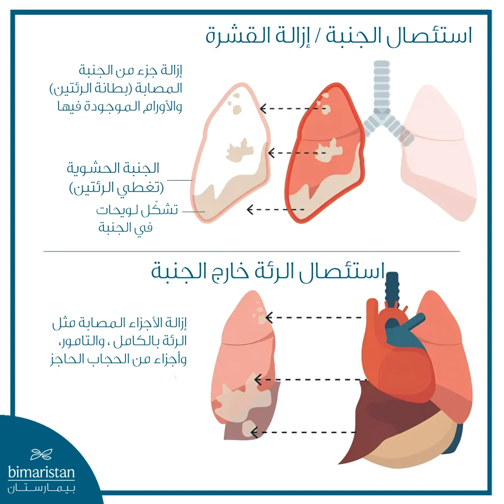 رسم يوضح جراحات ورم الظهارة المتوسطة في الرئة مثل استئصال الجنبة واستئصال الرئة الكامل